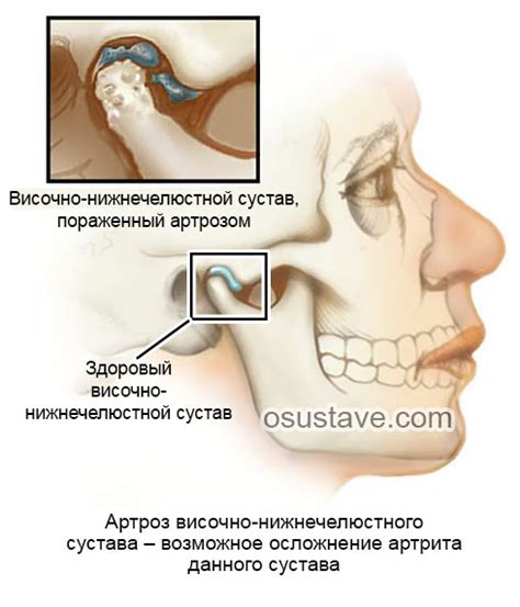 Причины и симптомы боли в челюстном суставе